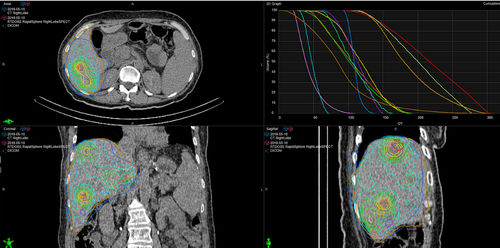 Программное обеспечение для обработки - RapidSphere - Varian Oncology - с системой отслеживания / для моделирования / для контурной обработки