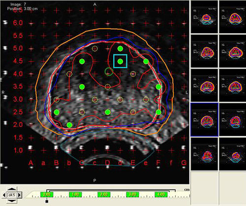 Программное обеспечение для визуализации - VariSeed™  - Varian Oncology - для планирования лечения / для импортации / медицинское