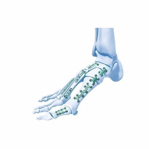 Компрессионная костная пластина плюсна - Double Medical Technology - фаланги стопы / предплюсна / блокируемая