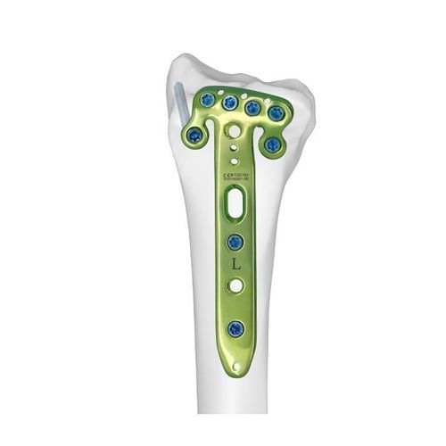 Компрессионная костная пластина лучевая кость - Double Medical Technology - дистальная / блокируемая