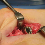 Имплантат межфалангового сустава стопы - HemiCAP DF®  - Arthrosurface