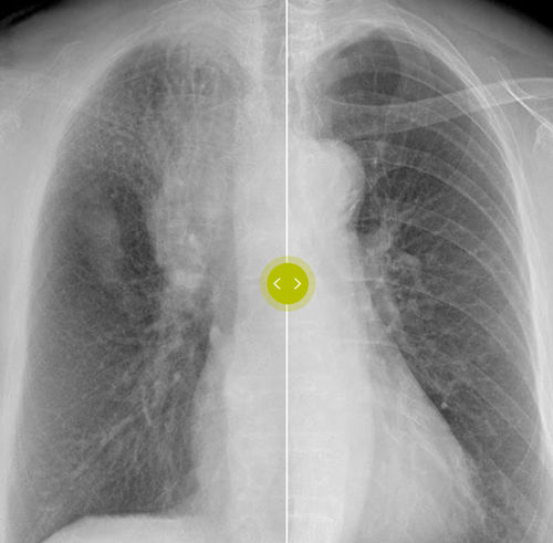 Программное обеспечение для улучшения изображений - Philips Healthcare - медицинское / рентгенографии / кости