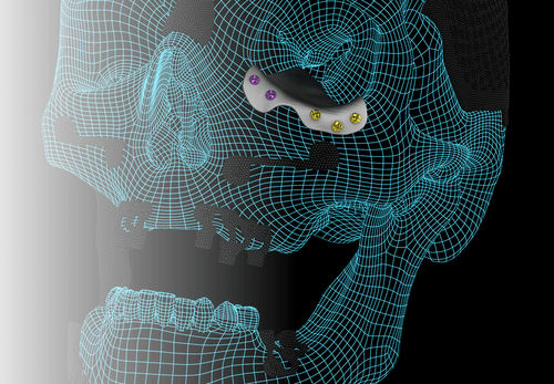 Имплантат параорбитальной области на заказ - ORBIT - A.B. Dental Devices
