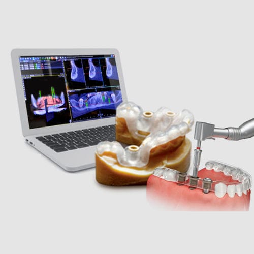 Программное обеспечение для управляемой хирургии - Implant3D - B&B DENTAL - для стоматологической имплантологии / для анализа / для визуализации 3D