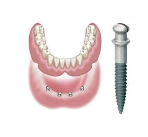 Конический зубной имплантат - ATLAS  - DENTATUS AB   - из титана / внешний / одномоментный