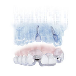 Программное обеспечение для стоматологической имплантологии - SIMPLANT® - DENTSPLY Implants GmbH - для моделирования зубного импланта / для планирования