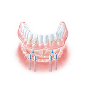 Абатмент из металла - ANKYLOS® SynCone® - DENTSPLY Implants GmbH - прямой