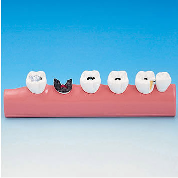Анатомическая модель для стоматологии - PE-TDS005 - Nissin Dental Products Inc.   - для образовательных целей / кариес