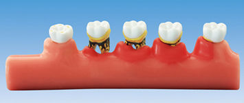Анатомическая модель для стоматологии - PE-PER010 - Nissin Dental Products Inc.   - ребра / острого одонтогенного периостита / для образовательных целей