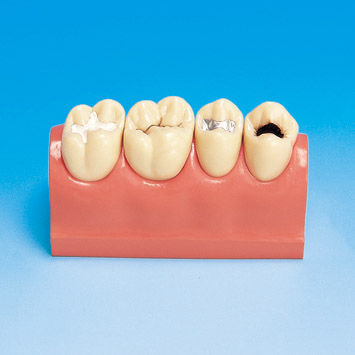Анатомическая модель для стоматологии - PE-STP007 - Nissin Dental Products Inc.   - для образовательных целей / кариес