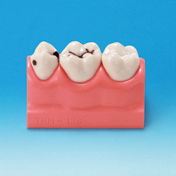 Анатомическая модель для стоматологии - PE-STP008 - Nissin Dental Products Inc.   - для образовательных целей / кариес
