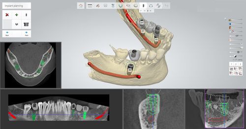 Программное обеспечение для планирования - Thommen Medical AG   - для управляемой хирургии / для стоматологической имплантологии