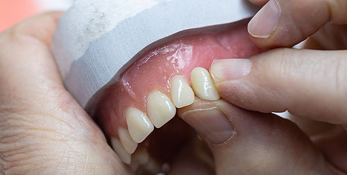 Стоматологический протез из композита - VITAPAN®  - VITA Zahnfabrik H. Rauter GmbH & Co.KG   - для передних зубов