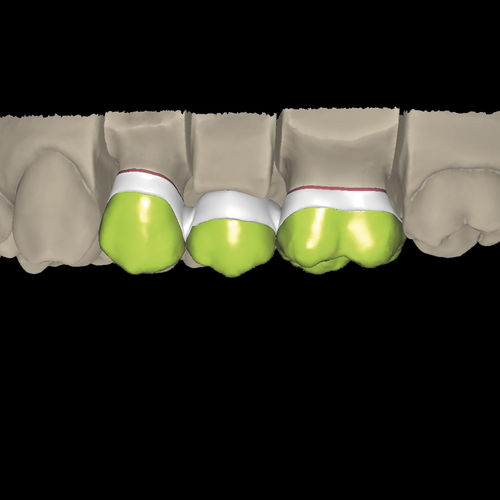 Модуль программного обеспечения для стоматологических лабoраторий - Overpress crowns and overpress bridges - Zirkonzahn - CAO / для проектирования зубных протезов / FAO