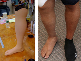 Эстетический протез нога - Boston Orthotics + Prosthetics - для взрослых