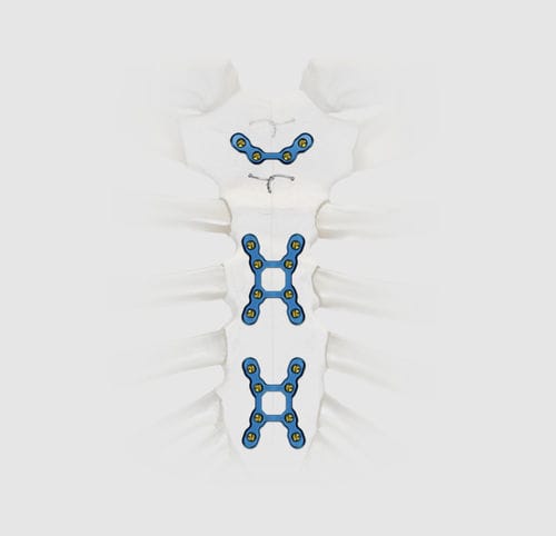 Компрессионная костная пластина для грудины - SternaLock® Blu - Zimmer Biomet - блокируемая / из титана