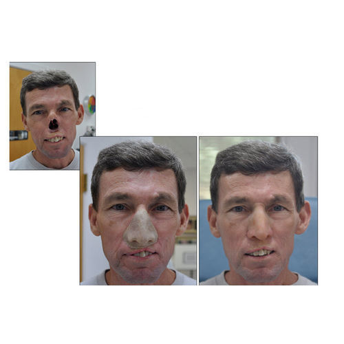 Эстетический протез для носа - RealLifeSkin™ - RealLifeSkin - для взрослых