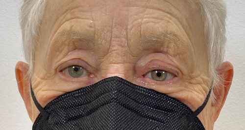 Эстетический протез для глаз - Scleral Shells - The Anaplastology Clinic - для взрослых