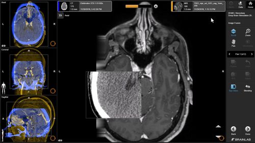Медицинское программное обеспечение - Brainlab - клиническое / анатомическое / хирургическое