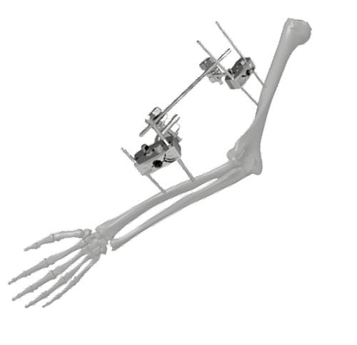 Внешний фиксатор для локтя - 206303 - SOFEMED International - трубчатый