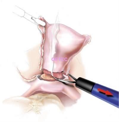 Лапароскопический электрод - LapLoop  - OPTEC Endoscopy Systems - проволочная петля / монополярный
