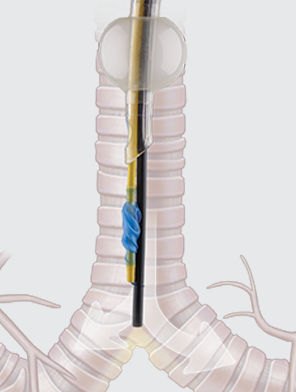 Эндобронхиальный блокер 2 люмена - COOK Medical - 1 люмен