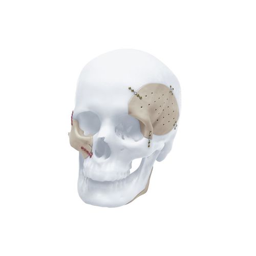 Черепной имплантат на заказ - TRUMATCH™ - Depuy Synthes