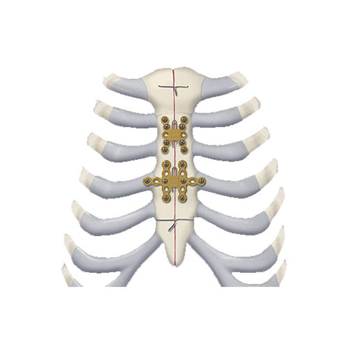 Костная пластина для артродеза для грудины - 460 series - Depuy Synthes - для ребер / блокируемая / из титана