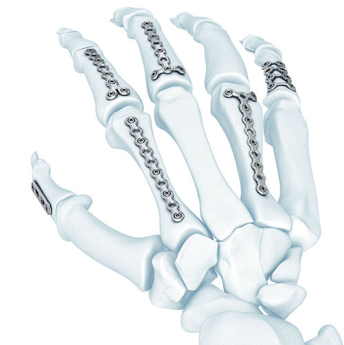 Компрессионная костная пластина пясть - LCP® - Depuy Synthes - блокируемая / металлическая