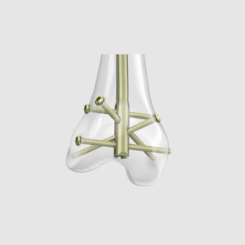 Интрамедуллярный штифт бедренная кость - RFN-ADVANCED™ - Depuy Synthes - дистальная фиксация / металлический