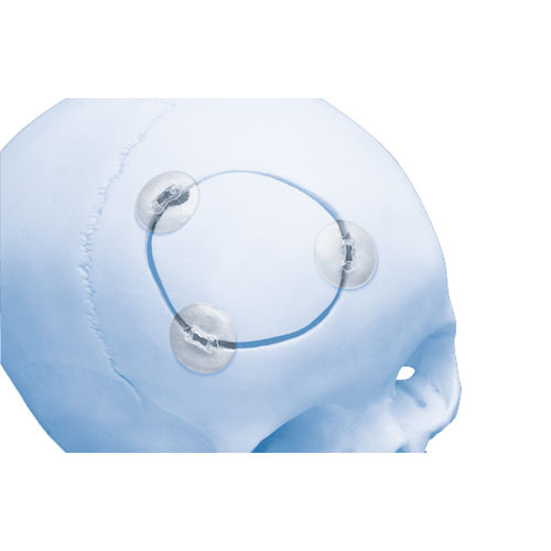 Система фиксации костного лоскута рассасывающаяся - RAPIDSORB™  - Depuy Synthes