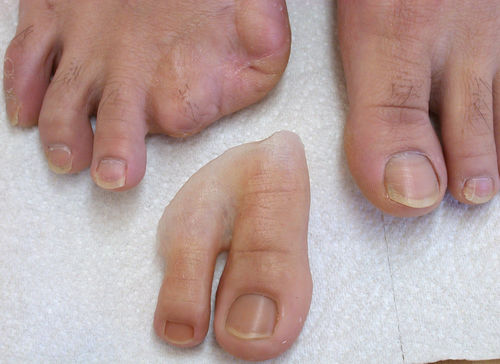 Эстетический протез палец ноги - Aesthetic Prosthetics - для взрослых