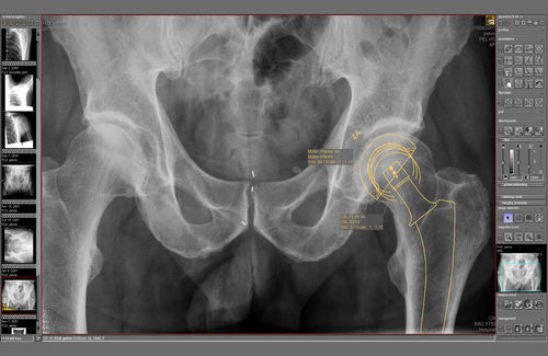 Модуль программного обеспечения для планирования - dicomPACS® Prosthesis  - OR Technology - Oehm und Rehbein - для медицинских снимков / для ортопедической хирургии