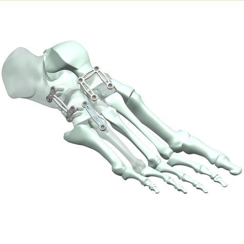 Костная пластина для артродеза для тарзометатарзального сустава - HJ-Expandable 01 - Health-Joy Medical - боковая / дистальная / дорсальная