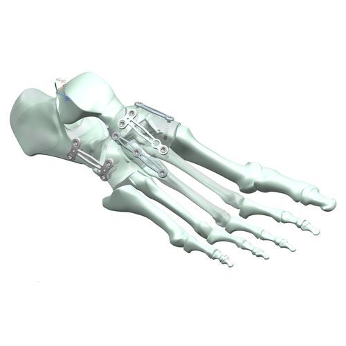 Костная пластина для артродеза плюснефаланговый сустав - HJ-Expandable 02 - Health-Joy Medical - для тарзометатарзального сустава / для таранно-ладьевидного сустава / плюсна