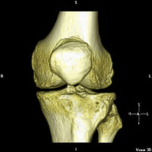 Программное обеспечение для проектирования коленных протезов - iFit® - ConforMIS - анатомическое / для ортопедической хирургии