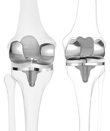 Коленный протез с 3 отсеками - iTotal® CR - ConforMIS - со скольжением, с сохранением крестообразных связок / с цементом