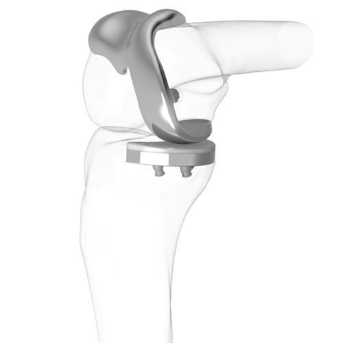 Коленный протез с одним отсеком - iDuo®  - ConforMIS - с фиксированным вкладышем / с цементом
