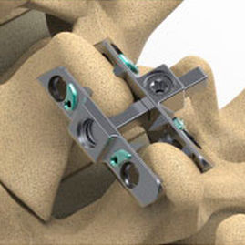 Имплантант межпозвоночного диска для поясничной зоны - Reli™ SP - Precision Spine - крестцовый / для торакальной зоны
