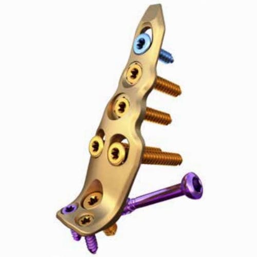 Компрессионная костная пластина малоберцовая кость - ORTHOLOC™ - Wright Medical Technology - дистальная / блокируемая / неблокируемая