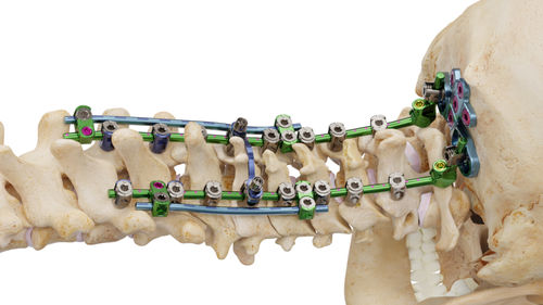 Затылочно-шейно-грудная система остеосинтеза - Invictus® OCT - Alphatec Spine - через задний отдел