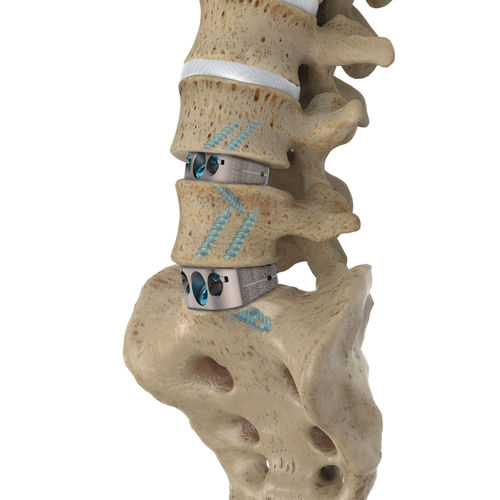 Межтеловой кейдж для пояснично-крестцовой зоны - IdentiTi™ ALIF Standalone - Alphatec Spine - через передний отдел / из титана