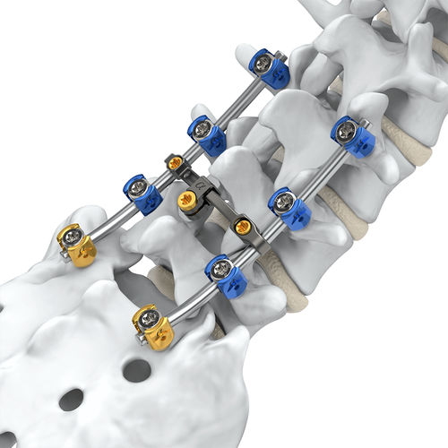 Система остеосинтеза для пояснично-крестцовой зоны - Arsenal™  - Alphatec Spine - через задний отдел
