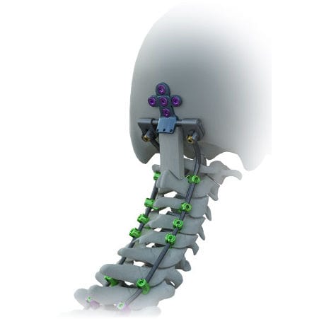Затылочно-шейная система остеосинтеза - Avalon® - Alphatec Spine - через задний отдел