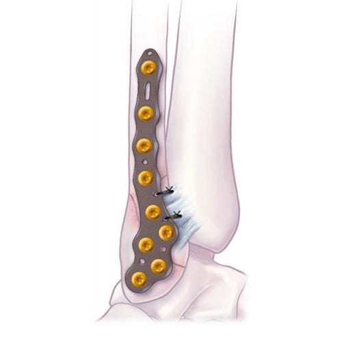 Компрессионная костная пластина малоберцовая кость - VOLITION™  - Ortho Solutions - для лодыжки / дистальная / боковая