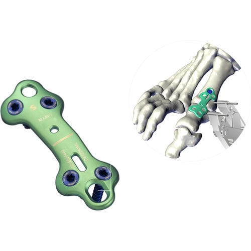 Костная пластина для артродеза передний отдел стопы - UltOS™ - Ortho Solutions - фаланги стопы / блокируемая / неблокируемая
