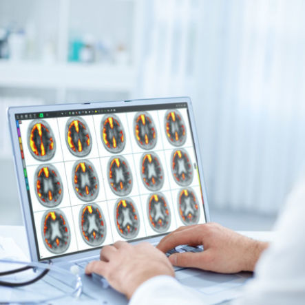 Программное обеспечение для обработки изображений головного мозга - MIMneuro® - MIM Software - для анализа / для визуализации 3D / для диагностики