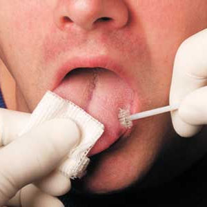 Ротовая цитологическая щетка - OralCDx® - CDx Diagnostics - для одноразового применения