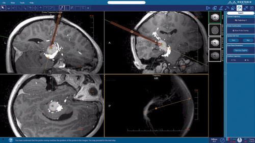 Программное обеспечение для планирования - NeuroBlate ® SoftwareTM NeuroBlate ® - Monteris Medical - для приобретения / для контурной обработки / для медицинских снимков