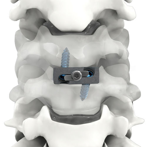 Межтеловой кейдж шеи - PRO-LINK® - Life Spine - через передний отдел / из титана